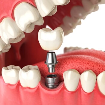 A 3D illustration of dental implants