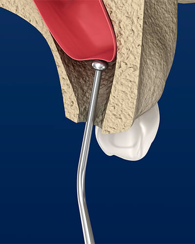 A 3D graphic showing a dental instrument being used for bone grafting