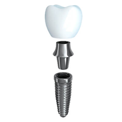 A Illustration of a dental implant