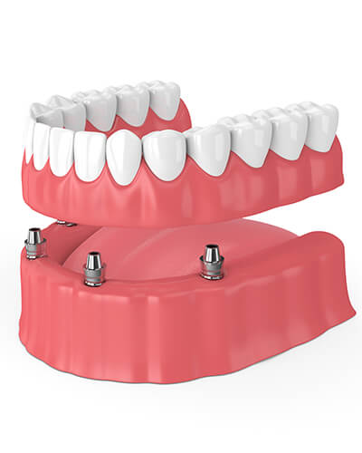 A 3D illustration of Implant-Retained Dentures also available in Bellevue and Issaquah, WA from Dr. Raval