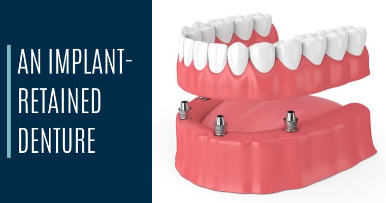 An implant-retained denture