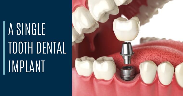 A single tooth dental implant