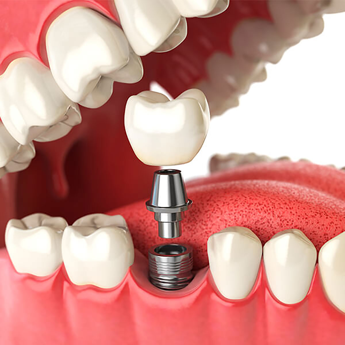 Zirconium Implants Bellevue WA - Zirconium Dental Implant Bellevue -  Zirconium Tooth Implant Bellevue